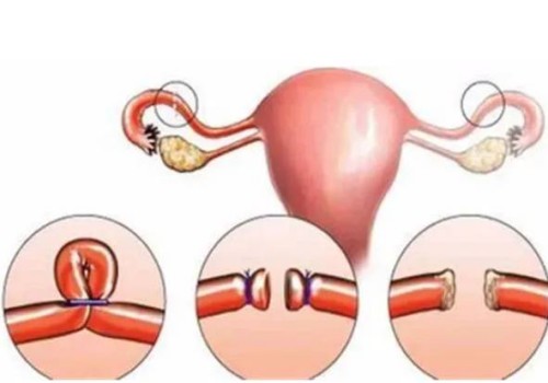 寧波供卵試管：子宮腺肌癥可以通過中醫(yī)治療，這些緩解子宮腺肌癥方法也不要忽略