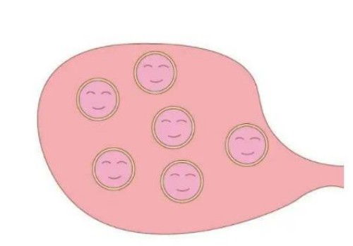 寧波試管嬰兒價格：怎樣解決子宮肌瘤帶來的困擾？