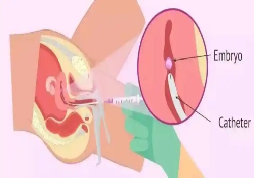 偶發(fā)還是遺傳？看看4號染色體三體異?，F(xiàn)象的真正原因