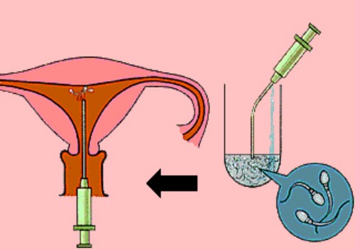 盤點(diǎn)試管嬰兒希愛力的正確使用方法，注意時(shí)間和劑量才是關(guān)鍵