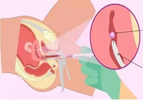 寧波三代試管助孕：產(chǎn)婦坐月子是42天還是30天？到底哪一個(gè)正確